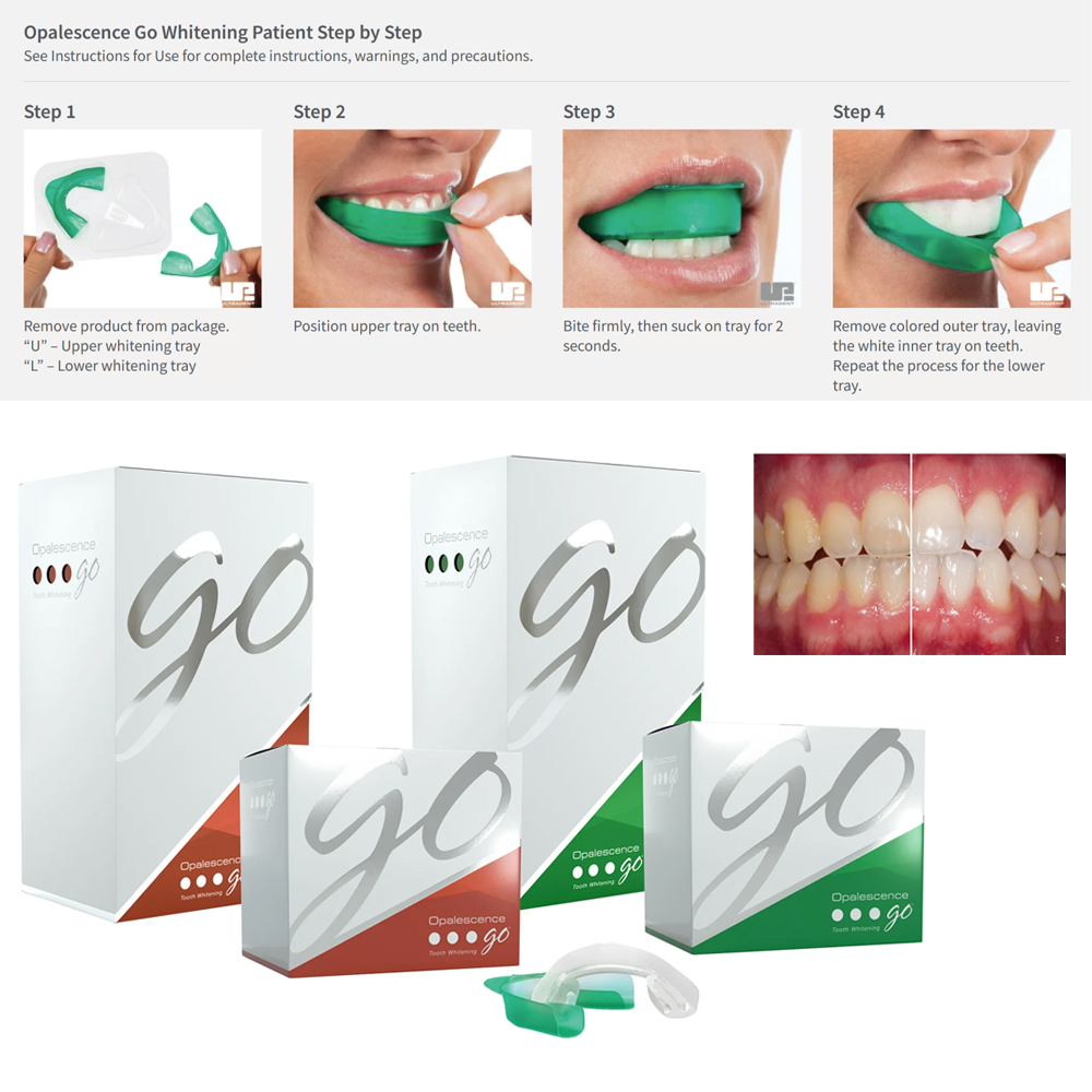 Teeth Whitening Gel Opalescence - 유백광 고 치아 미백 트레이, 집에서