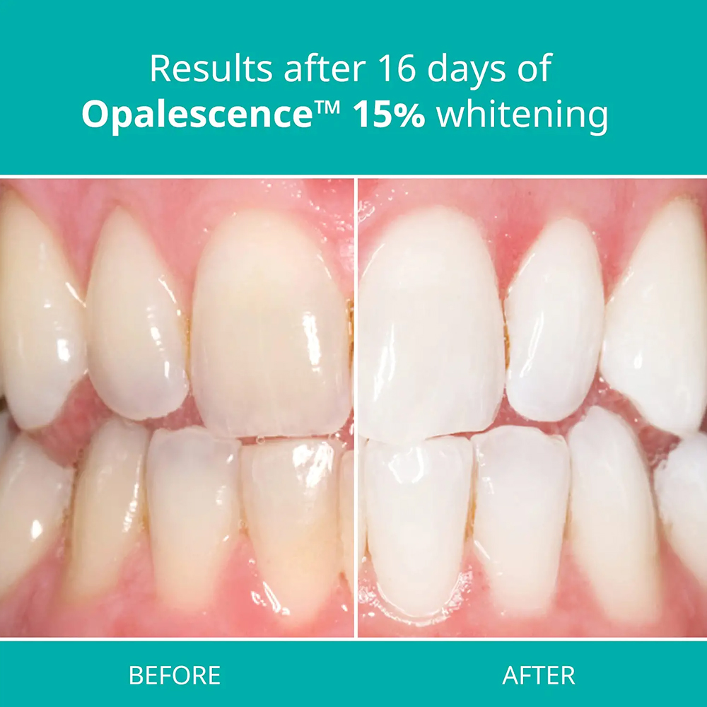 치아 미백 젤 홈 키트 치과 전문 과산화물 주사기 수소 - Teeth Whitening Gel Opalescence 리뷰 및 가격