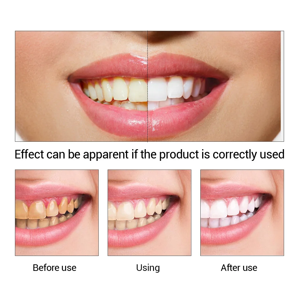 FTEENPLY 치아 미백 에센스 파우더 구강 위생 청 - Teeth Whitening Diy 리뷰 및 가격