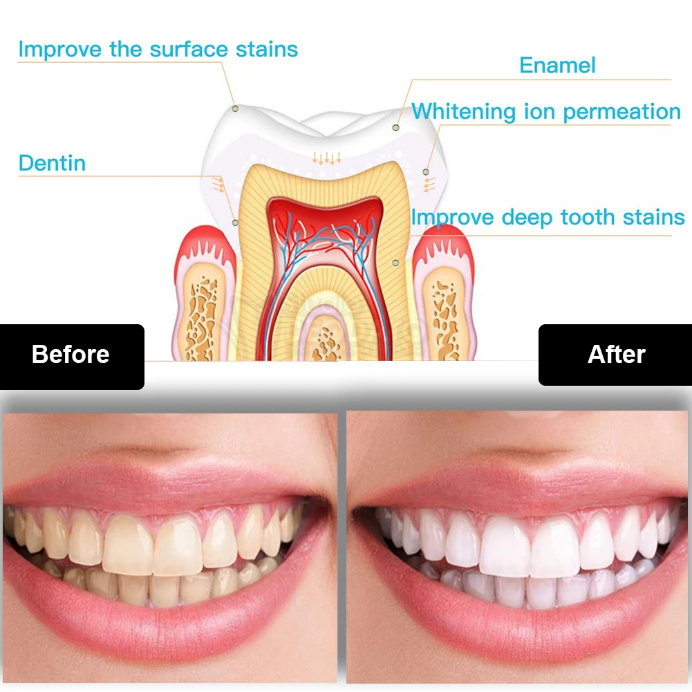 치과 치아 미백 키트 미니 16 LED 콜드 라이트 3 - Teeth Whitening Diy 리뷰 및 가격