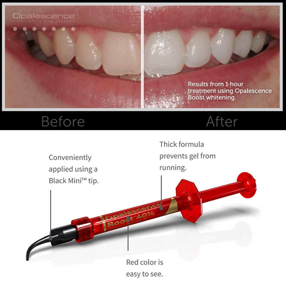 울트라덴트 오팔레센스 부스트 PF 40% 치과용 미백  - Teeth Whitening Gel Opalescence 리뷰 및 가격